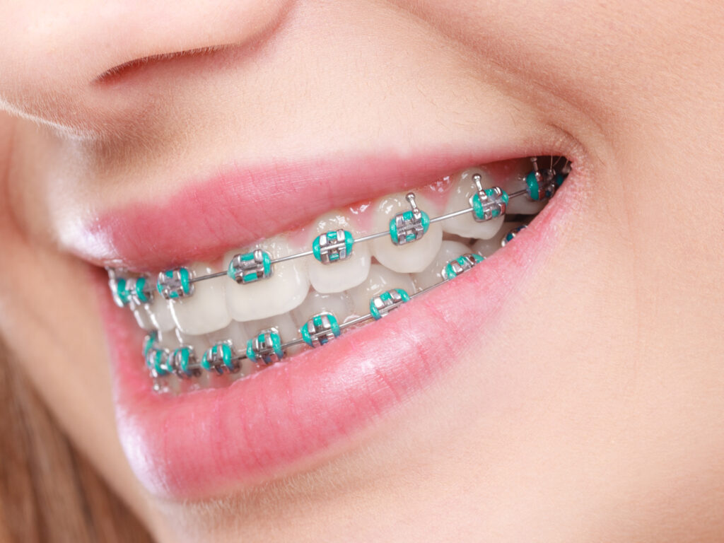 west covina orthodontics healthy smile group